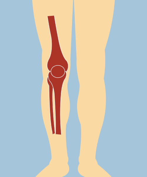 Osteoarthritis